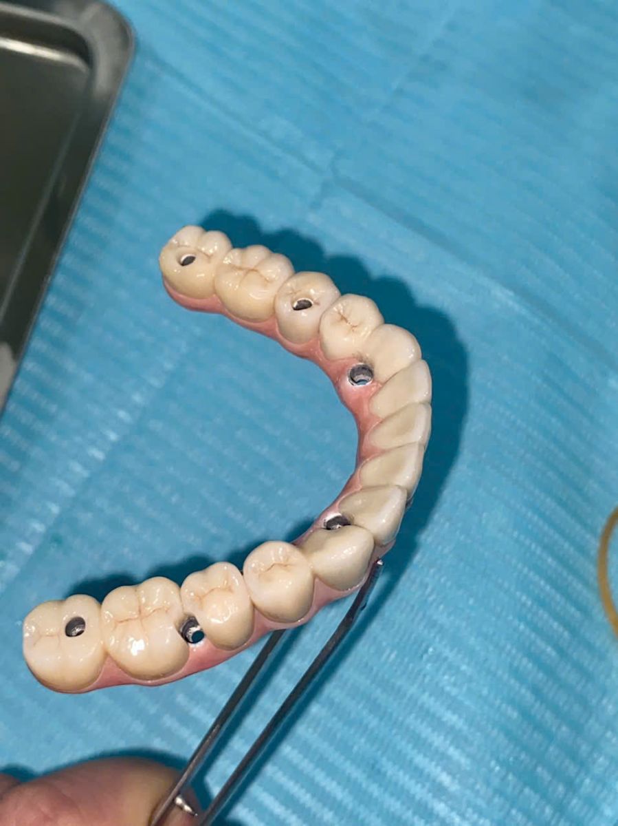 Hình ảnh phục hình răng giả sau khi cấy ghép Implant All On 6 tại Nha khoa SV quận 3