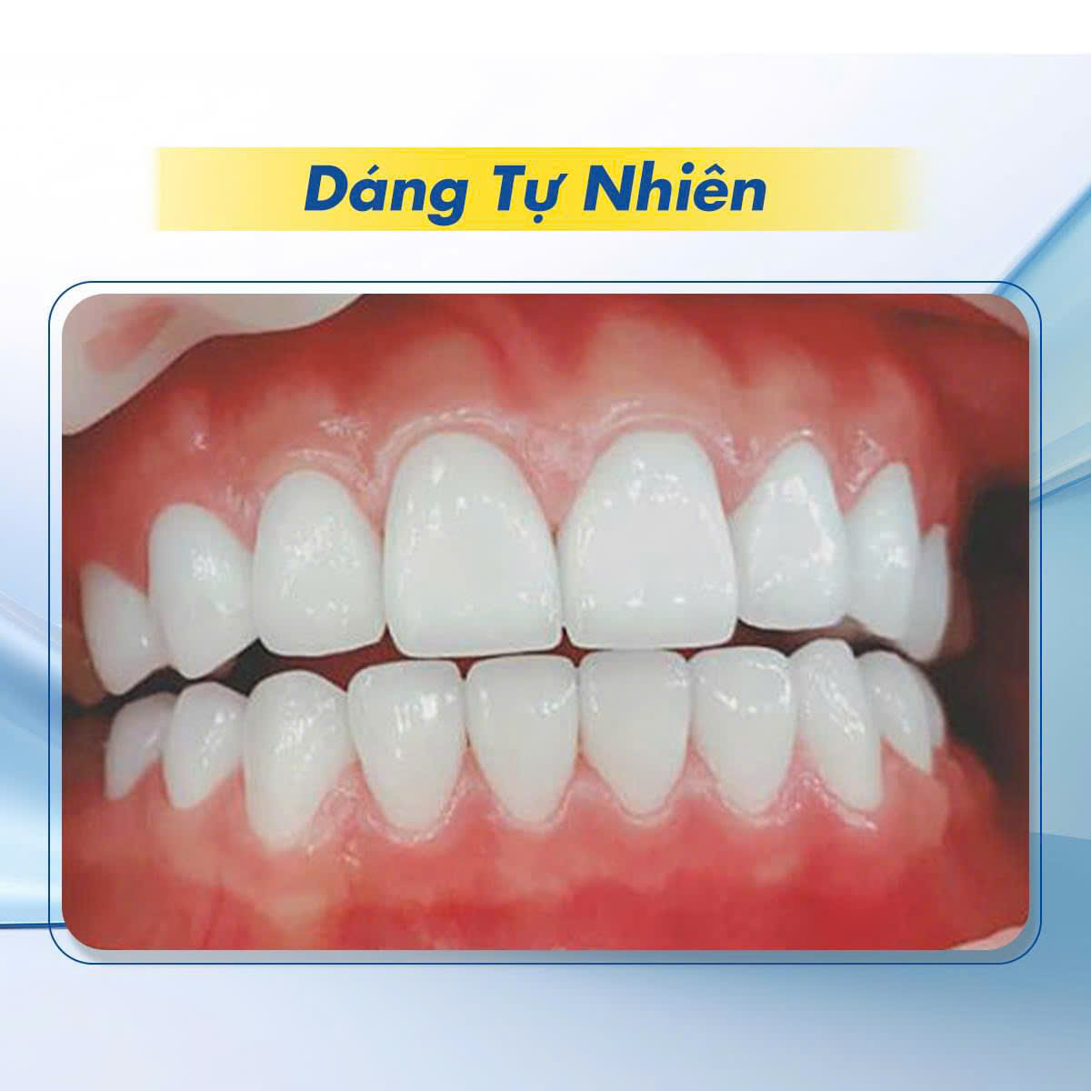 Hình ảnh dáng răng sứ tự nhiên tại Nha khoa SV quận 3