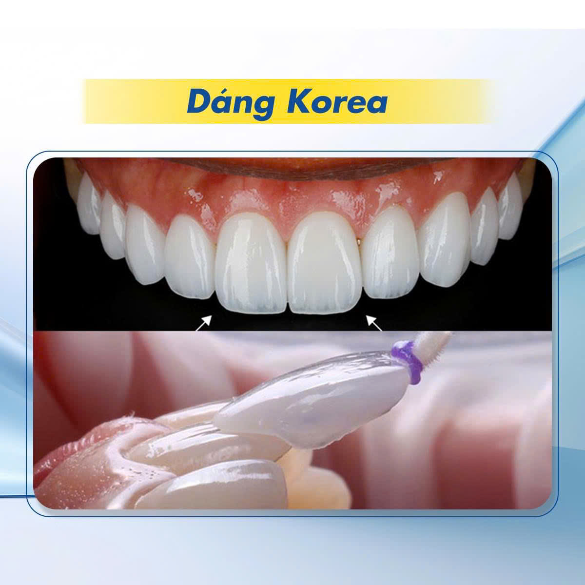 Hình ảnh làm răng sứ dáng Korea tại Nha khoa SV quận 3