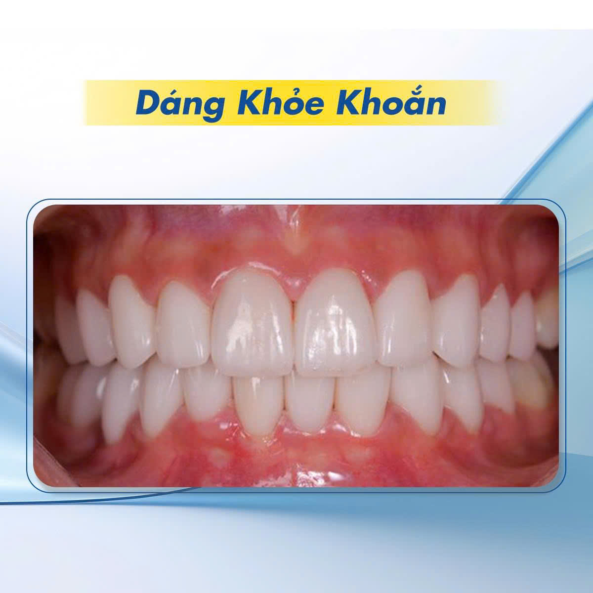 Hình ảnh dáng răng sứ khỏe khoắn tại Nha khoa SV quận 3