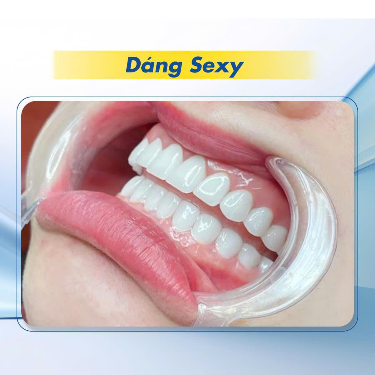 Hình ảnh dáng răng sứ Sexy tại Nha khoa SV quận 3