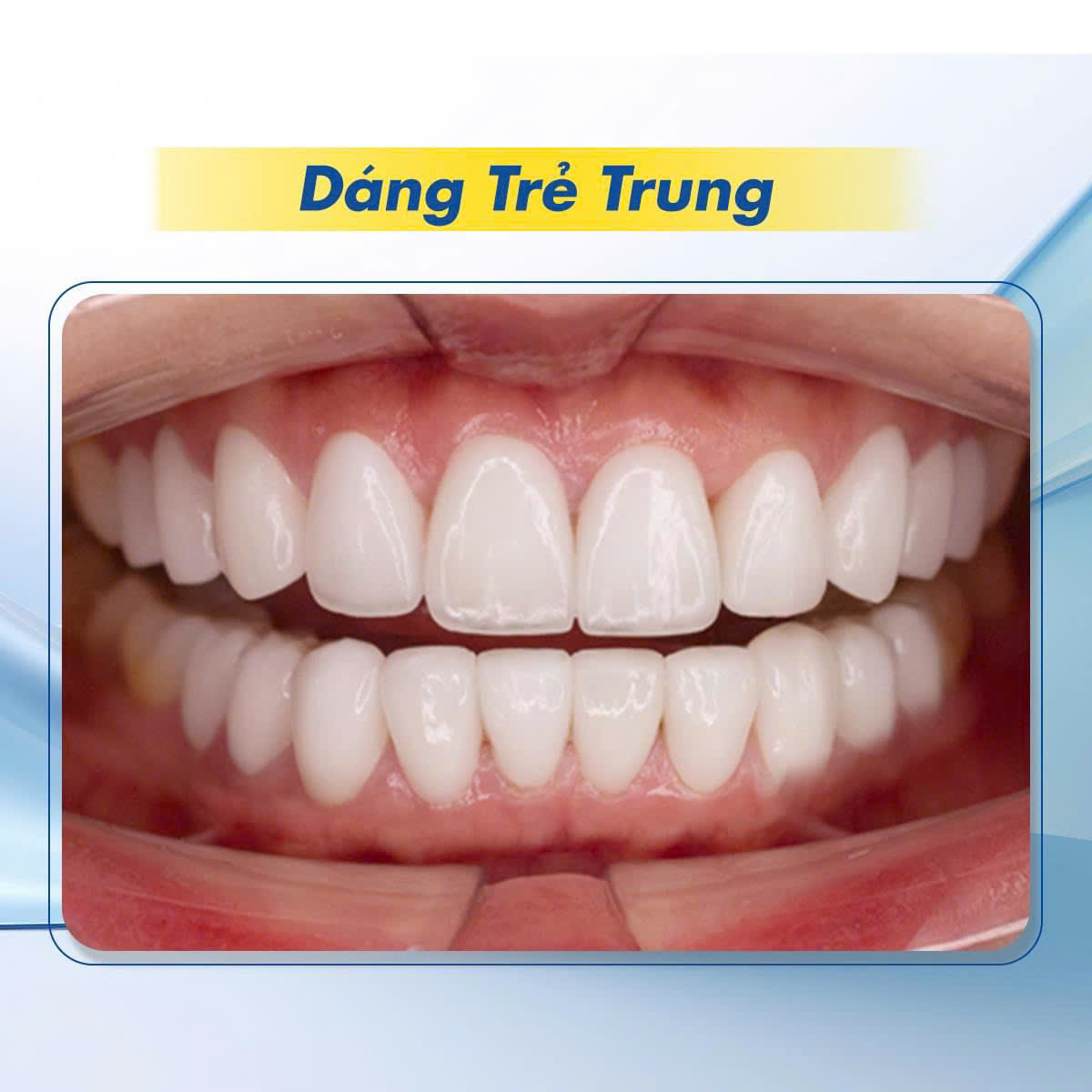 Hình ảnh dáng răng trẻ trung tại Nha khoa SV quận 3