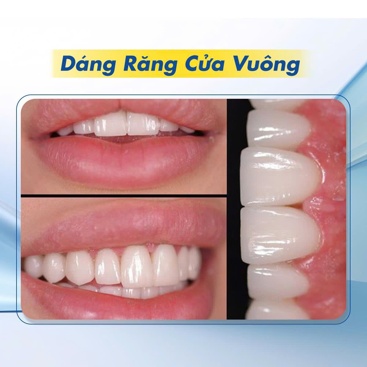 Hình ảnh Dáng răng cửa vuông tại Nha khoa SV quận 3