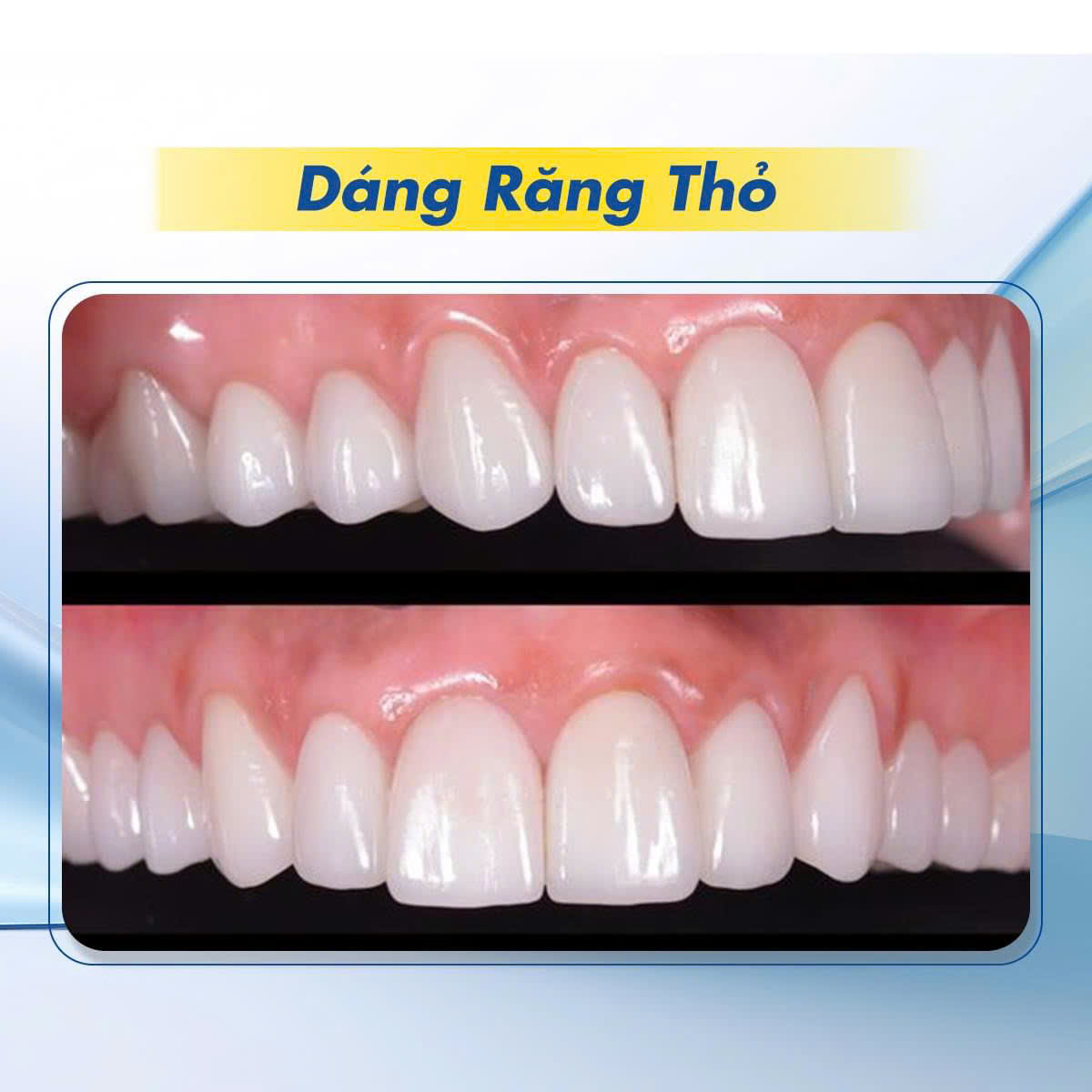 Hình ảnh dáng răng thỏ tại Nha khoa SV quận 3