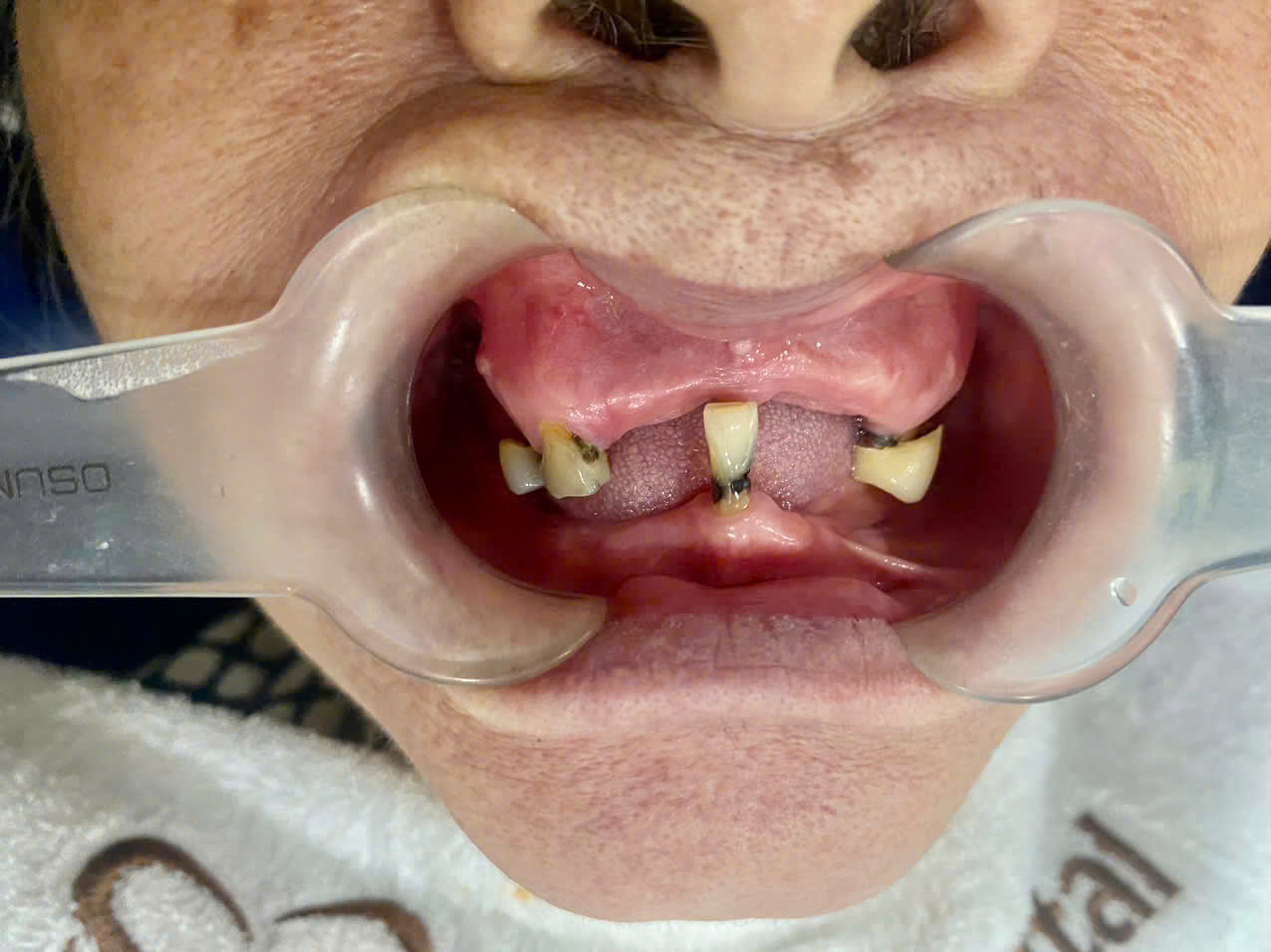 Trường hợp nên trồng răng Implant All On 6