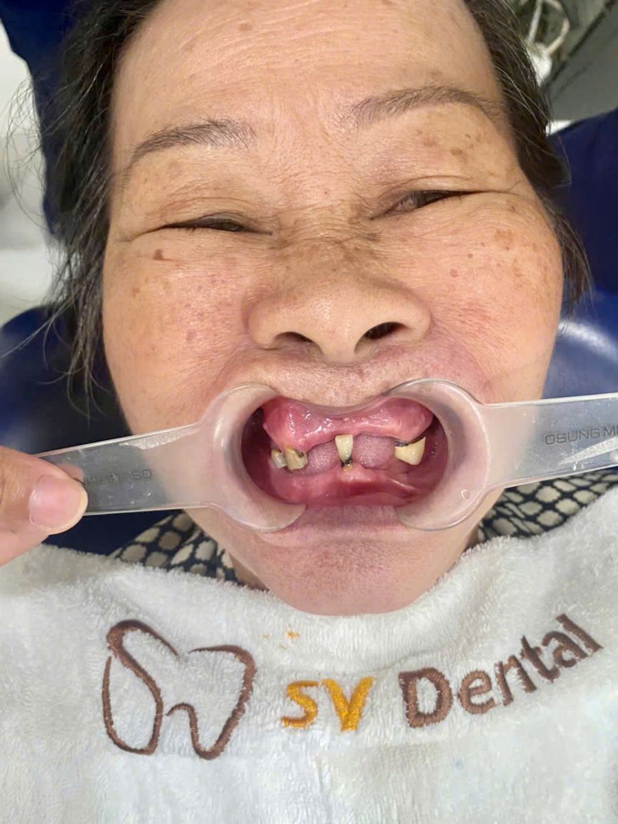 Hình ảnh khách hàng trước khi làm răng sứ thẩm mỹ tại Nha khoa SV quận 3