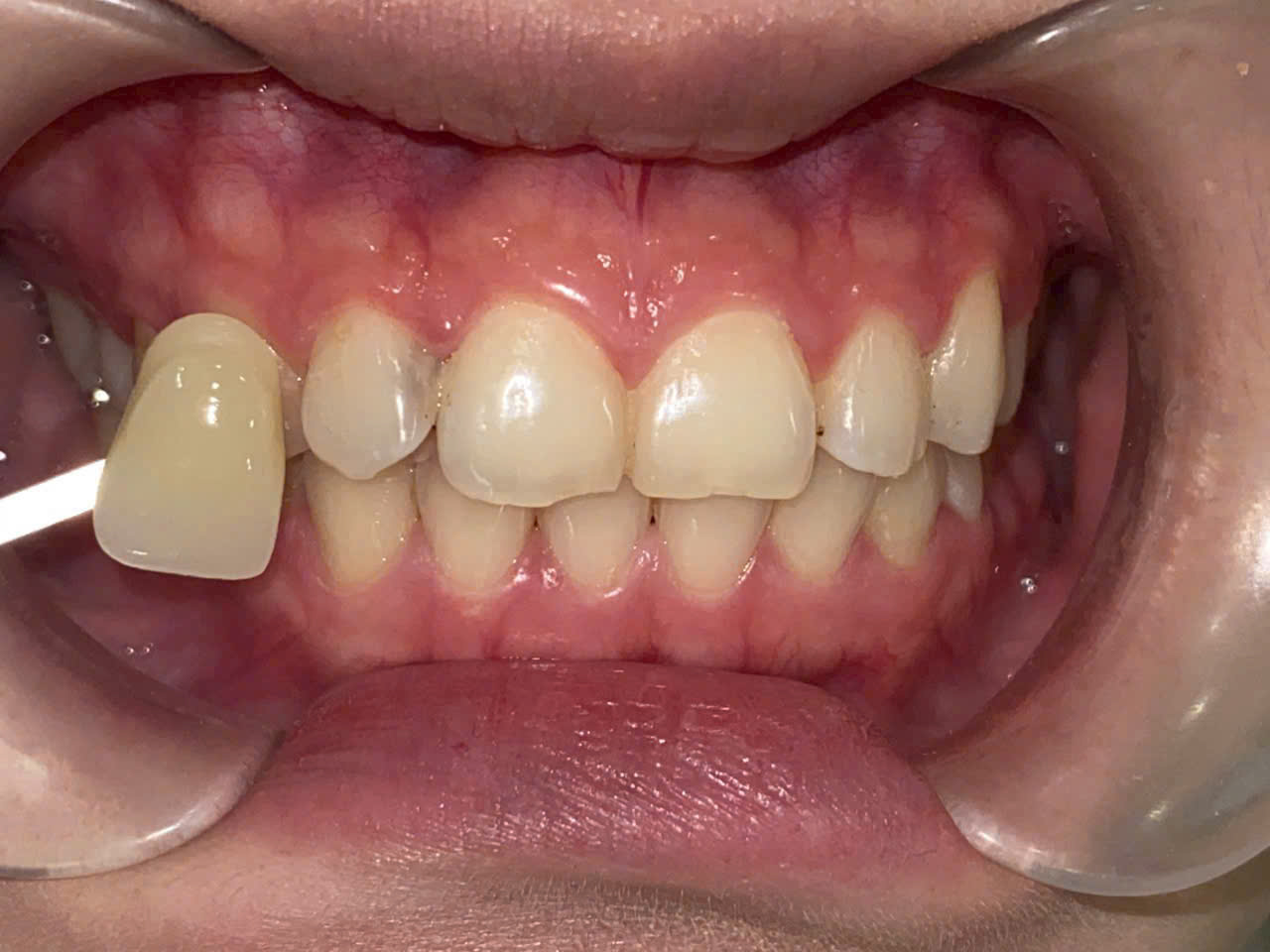 Hình ảnh trước khi dán sứ Non-prep Veneer tại Nha khoa SV quận 3