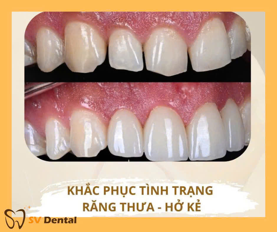 Hình ảnh làm mặt dán sứ Non-prep Veneer tại Nha khoa SV quận 3