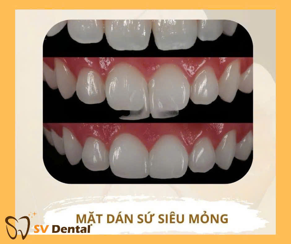 Mặt dán sứ Non-prep Veneer mang lại nụ cười tự tin cho khách hàng 