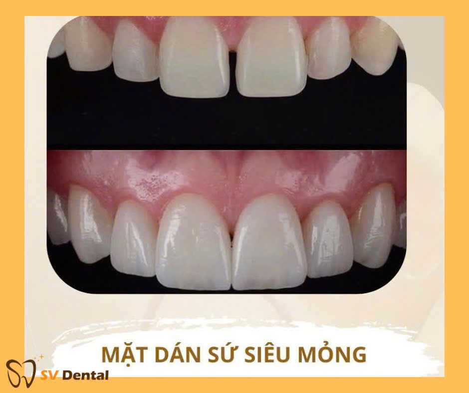 Mặt dán sứ siêu mỏng, thay đổi màu sắc răng theo ý muốn ​​​​​​​
