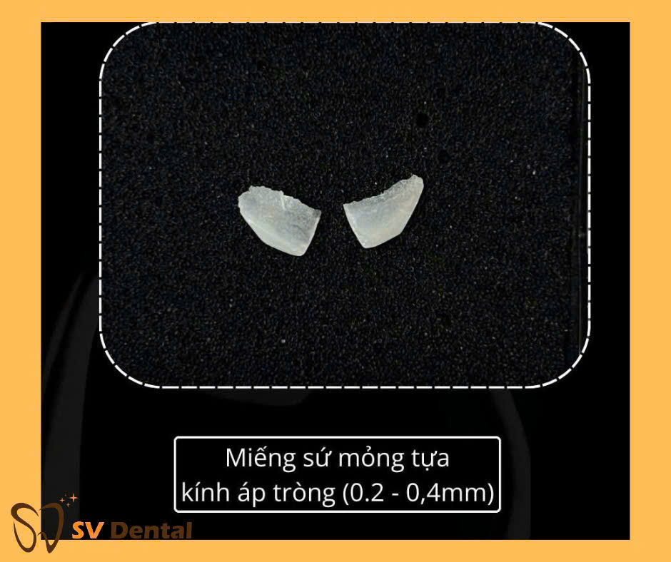 Mặt dán sứ Non-prep Veneer mỏng tựa kính áp tròng tại Nha khoa SV quận 3