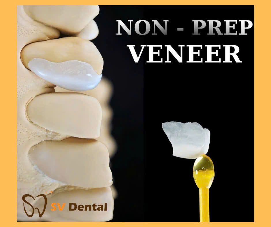 Hình ảnh giới thiệu mặt dán sứ Non-prep Veneer tại Nha khoa SV quận 3