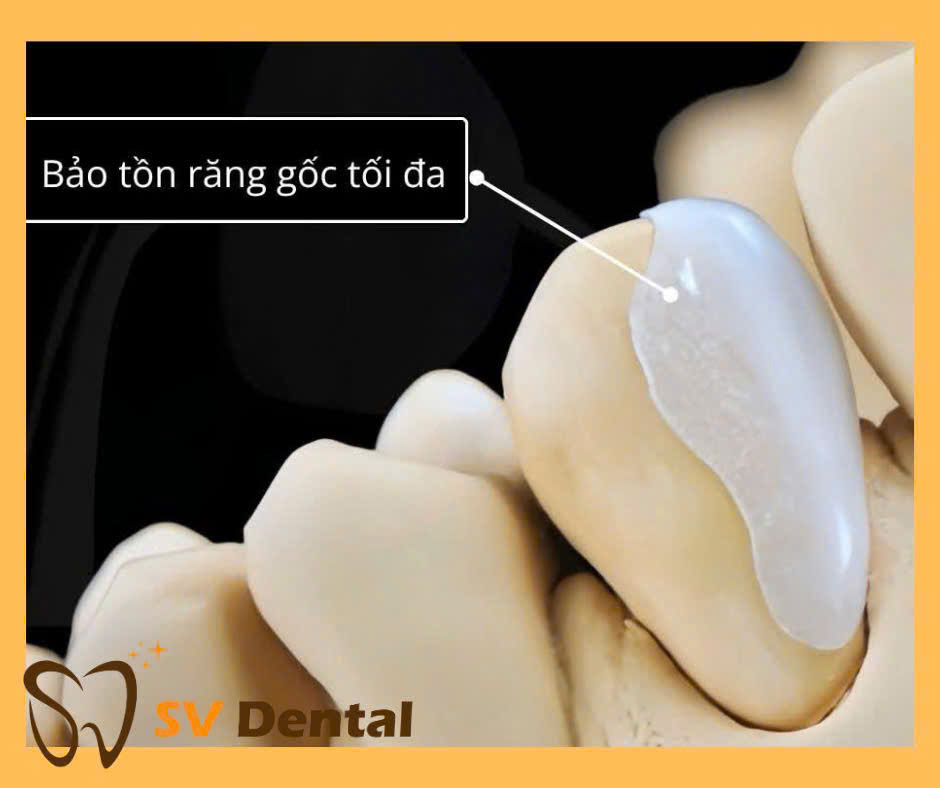 Mặt dán sứ Non-prep veneer tại Nha khoa SV quận 3