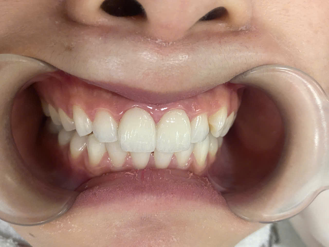 Hình ảnh sau làm làm mặt dán sứ Non-prep Veneer tại Nha khoa SV quận 3