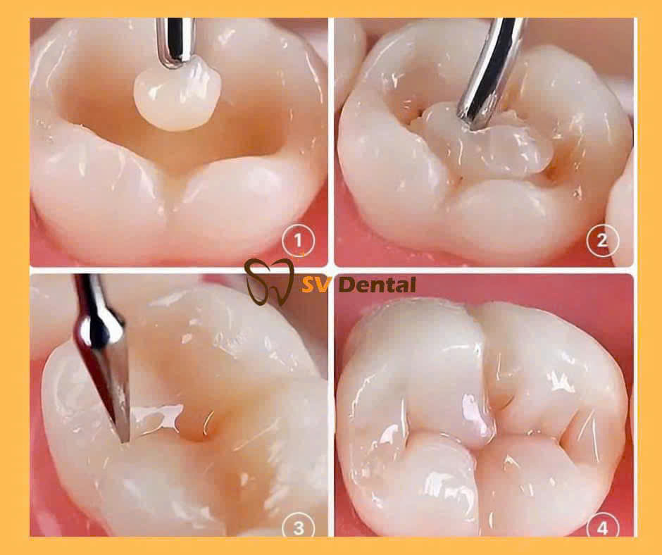 Hình ảnh dịch vụ trám răng sâu tại Nha khoa SV quận 3