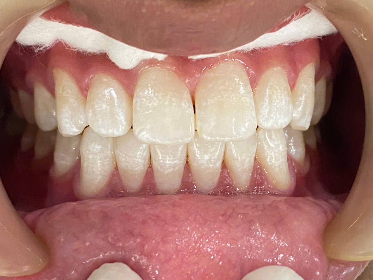 Cách ly vùng răng điều trị với đê cao su
